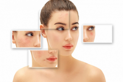 Totul despre peeling